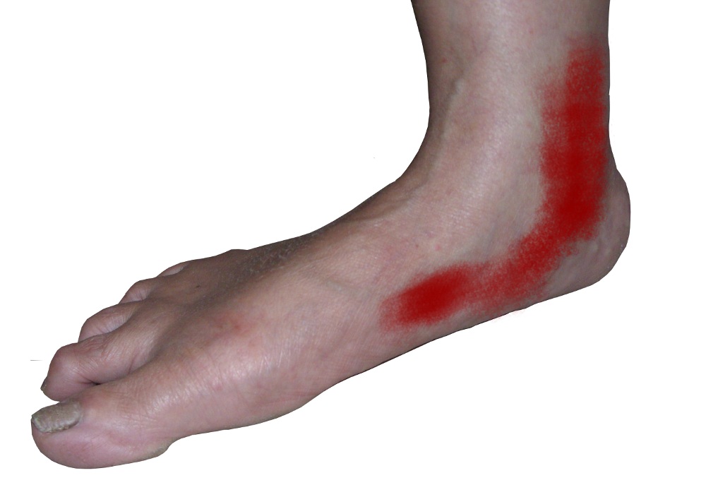 Adult acquired flatfoot deformity – fallen arches and flat feet