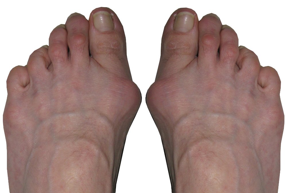 Хальгус вальгус. Hallux valgus 1 степени правой стопы. Hallux valgus правой стопы - 2 ст .. Hallux valgus всегда сочетается с :.