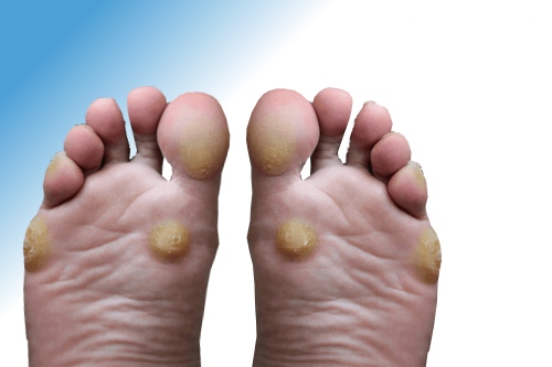 Podiatrist Callus Removal [Podiatrist Treatment for Calluses & Corns]